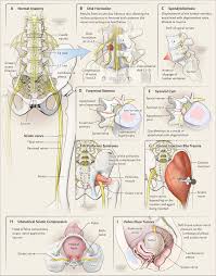 Image result for Sciatica