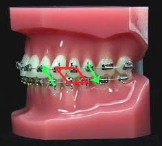 Braces usually require rubber bands at some point during the process to help them complete their job of straightening out teeth. Triangle Elastics Tyler Dumas And Reyes Specialists In Orthodontics