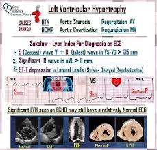 S wave depth in v1. Ccu Left Ventricular Hypertrophy Ecg Criteria Ccu Ecg Facebook