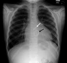 Image result for XRay Changes in Rheumatic Conditions