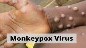 monkeypox scars