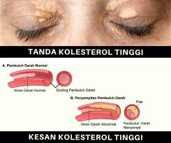 Tanda dan gejala kolesterol tinggi, serta cara mengatasinya. Tanda Kolesterol Tinggi Klinik Sabah