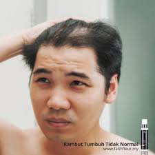 August 12, 2018august 11, 2018 by nor hanis ismail. Rawatan Rambut Gugur Lelaki Posts Facebook