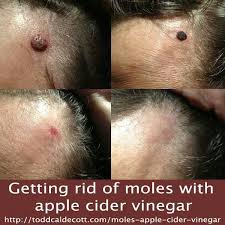 The common mole is a small burrowing clearly, the sooner you can get rid of moles the better! Getting Rid Of Moles With Apple Vinegar Health And Beauty Tips Remedies Natural Remedies