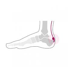 Comment soigner une tendinite au tendon d'achille. La Clinique Du Pied Lausanne