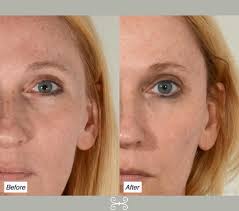 The temples are one of the most under-appreciated areas for filler. This  patient has a soft natural result from precise placement of filler to  support the lateral brow and improve hollowness of