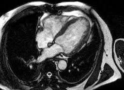 Although this condition is rare, the myocarditis foundation is hard at work raising awareness and working on finding a cure. Kardio Mrt Herz Radiologie Dusseldorf Mitte