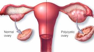 Tempat yang istimewa dalam perkembangan kanser endometrium diduduki oleh latar wanita dengan kesinambungan fungsi haid selepas 50 tahun, terutama dengan mioma uterus. Tanda Tanda Awal Kanser Rahim Yang Anda Wajib Tahu Islam Itu Indah