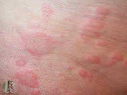 Image result for Hives