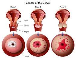 If you have an abnormal pap test or positive hpv test result, your doctor or nurse may. 10 Important Warning Signs Of Cervical Cancer That You Should Not Ignore Elite Readers