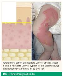 Verbrennungsverletzungen Bei Kindern Medmedia