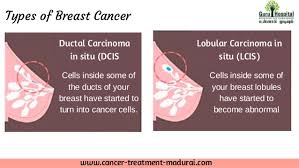 மார்பகப் புற்றுநோய் என்பது பெண்களுக்கே வரும் புற்று. Breast Cancer Treatment In Madurai Best Cancer Hospital In Tamil Na