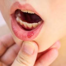 mouth ulcer in children