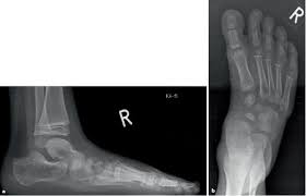 We did not find results for: Sichelfuss Serpentinenfuss Springerlink