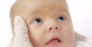 Image result for yellow scabs on the face in children