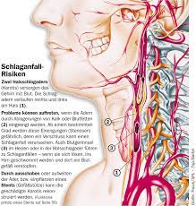 Halsschlagader Operation Schlaganfallvorsorge Gesundheitsberater Berlin