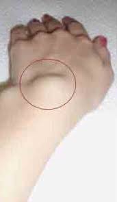 voici un remede naturel efficace pour traiter les lipomes natural pink eye remedy pinkeye remedies health