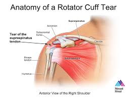 In addition to shoulder dislocations, other common injuries include rotator cuff tendon tears and broken bones including the humerus and collar terry gc, chopp tm. The Rotator Cuff Tear Rtc Champion Performance Physical Therapy