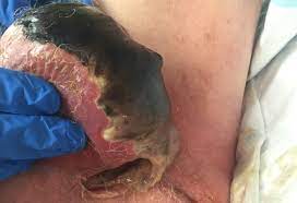 Check spelling or type a new query. Fournier Gangrene A Rare Flesh Eating Disease Clinical Advisor