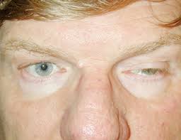 What does lid lag mean? How To Spot Dangerous Ptosis The Sequel