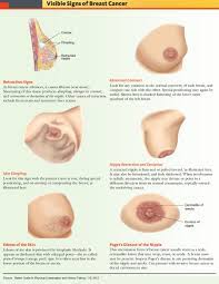 Advanced cancers can erode through the skin to cause open sores (ulceration) but are not necessarily painful. Breast Cancer Visible Signs On Physical Examination Retraction Grepmed
