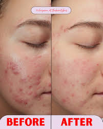 Lumecca arms before and after one treatment! Treat yourself this holiday  season to a glowing, even complexion