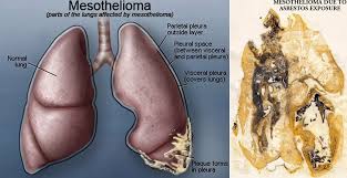Lung cancer is a leading type of cancer — and a leading killer — in the united states every year. Mesothelioma Cancer An Overview By Abdeslam Ait Hida Medium