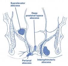Image result for Ischiorectal Abscess