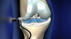 Knee liposuction is a very invasive procedure so it may take a long time for your body to recover. recovery time for arthoscopic knee surgery takes about 12 months on average to fully regain strength. Knee Arthroscopy Orthosports Orthopaedic Surgeons