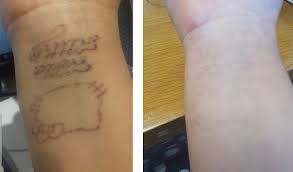Did your laser operator lie? Laser Tattoo Removal The Hogarth Medispa Chiswick West London