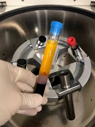 Complete them in a pdf reader (e.g. Platelet Rich Plasma Prp Peter Ch Ng Skin Specialist Kl Malaysia
