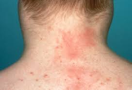 Lymphoma is a cancer that starts in the white blood cells this article looks at the two main types: Visual Guide To Non Hodgkin S Lymphoma
