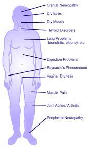 Sjogren S Syndrome Physiopedia