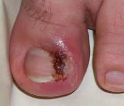 Image result for Paronychia feet