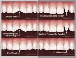 Pin By Melissa Burroughs On For A Better Me Dental Bonding Esthetic Dentistry Chipped Tooth