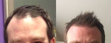 Do laser combs work for hair loss? Do Laser Caps Help Boost Hair Growth Kiierr Laser Hair Caps