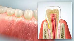 Zahnfleischentzundung Gingivitis Ursachen Happydens