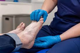 Image result for verruca