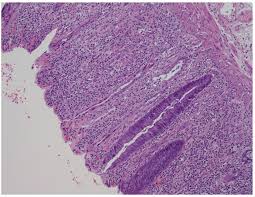 Image result for Radiation Colitis