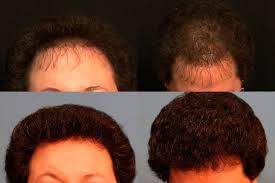Bridget haren hair & beauty salon woodquay. Hair Transplant Restoration Before After Photos Ennis Plastic Surgery