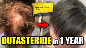 In contrast, propecia (finasteride) only inhibits one type, type ii. Crazy Dutasteride Hair Loss Reversal In Only 1 Year Youtube