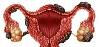 Endometriosis is a condition in which cells similar to those in the endometrium, the layer of tissue that normally covers the inside of the uterus, grow outside the uterus. Ù…Ø§ Ù‡Ùˆ Ø¹Ù„Ø§Ø¬ Ø¨Ø·Ø§Ù†Ø© Ø§Ù„Ø±Ø­Ù… Ø§Ù„Ù…Ù‡Ø§Ø¬Ø±Ø© Ù…ÙˆØ¶ÙˆØ¹