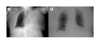 Image result for Atelectasis