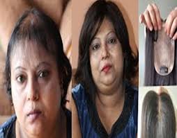 List Of Best Laser Hair Removal Treatment in Madhura Nagar