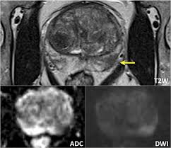 As long as the cancer hasn&#x27;t. The Radiology Assistant Prostate Cancer Pi Rads V2