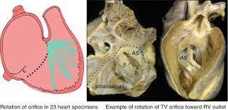 Sometimes, one of the leaflets is displaced downward into the ventricle, while another leaflet is larger than usual and may be abnormally attached to the wall of the ventricle. Ebstein Anomaly Thoracic Key