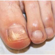 Image result for Pitting nails feet