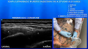 Image result for Scapulothoracic Injection
