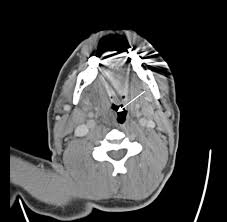 Image result for Uvulitis