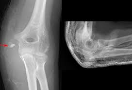 Surgery is recommended for children with displaced medial epicondylar fractures of more than 5 mm. Clinical Practice Guidelines Medial Epicondyle Fracture Of The Humerus Emergency Department